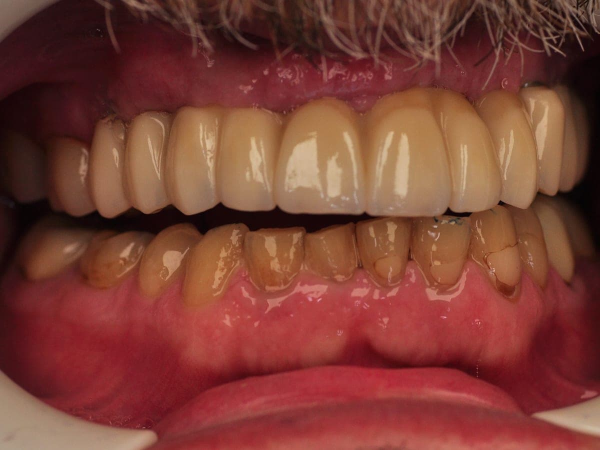 After full upper arch implant restoration