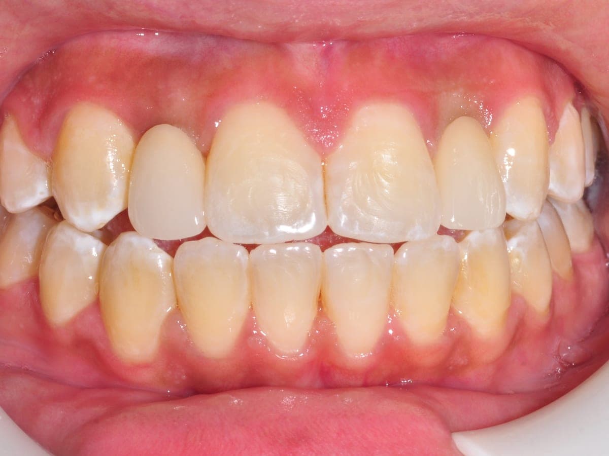 After multiple tooth implant crown restoration