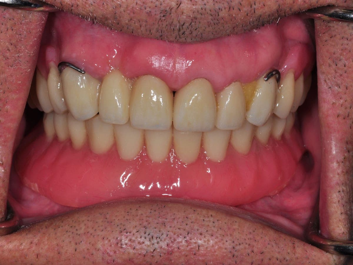 After full mouth implant reconstruction