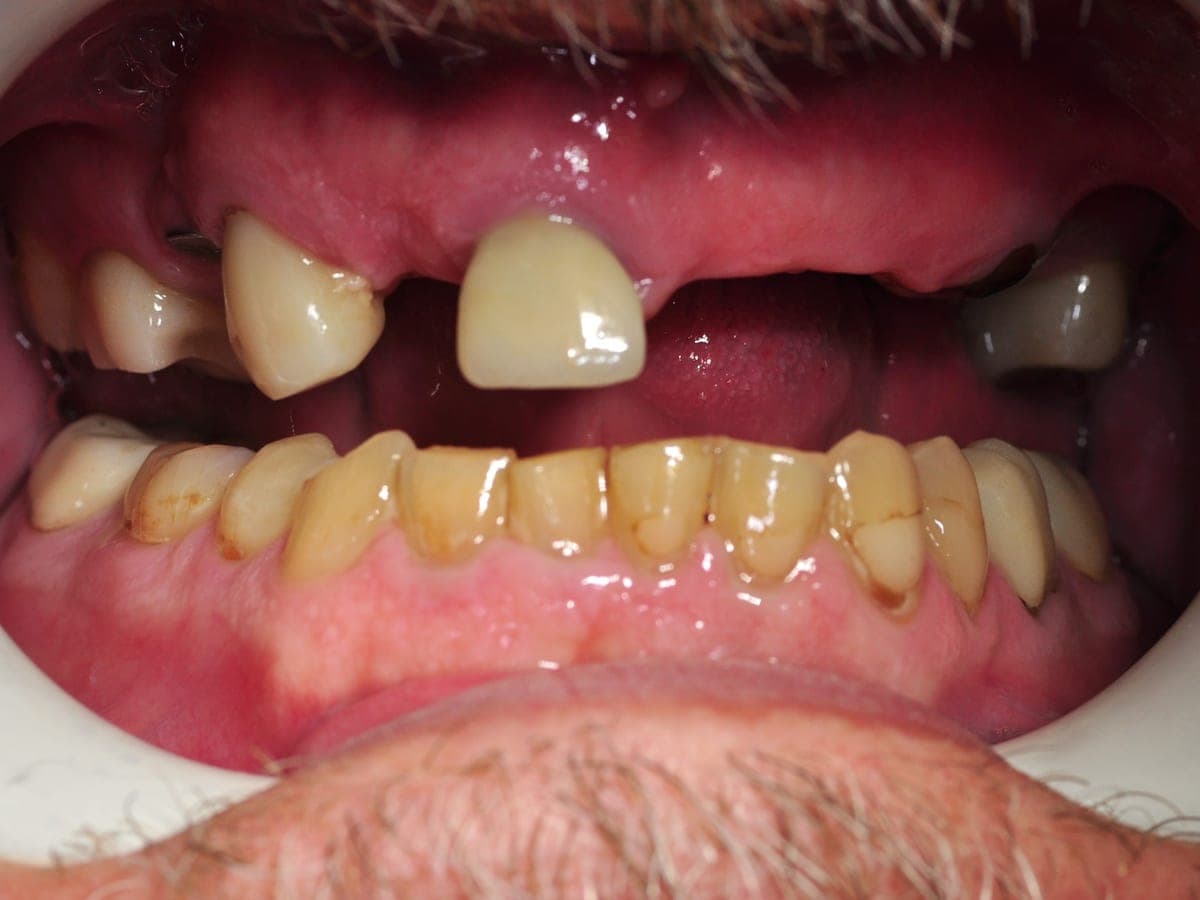 Before full upper arch implant restoration