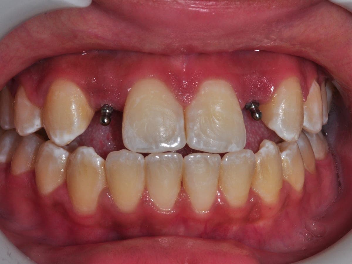 Before multiple tooth implant crown restoration