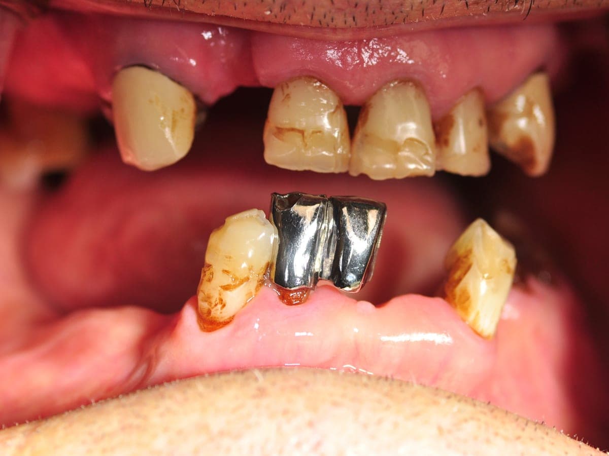 Before full mouth implant reconstruction