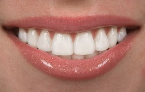 Veneers