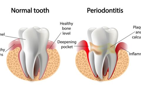 The Connection Between Gum Disease and Dementia