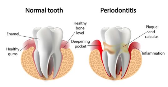 The Connection Between Gum Disease and Dementia