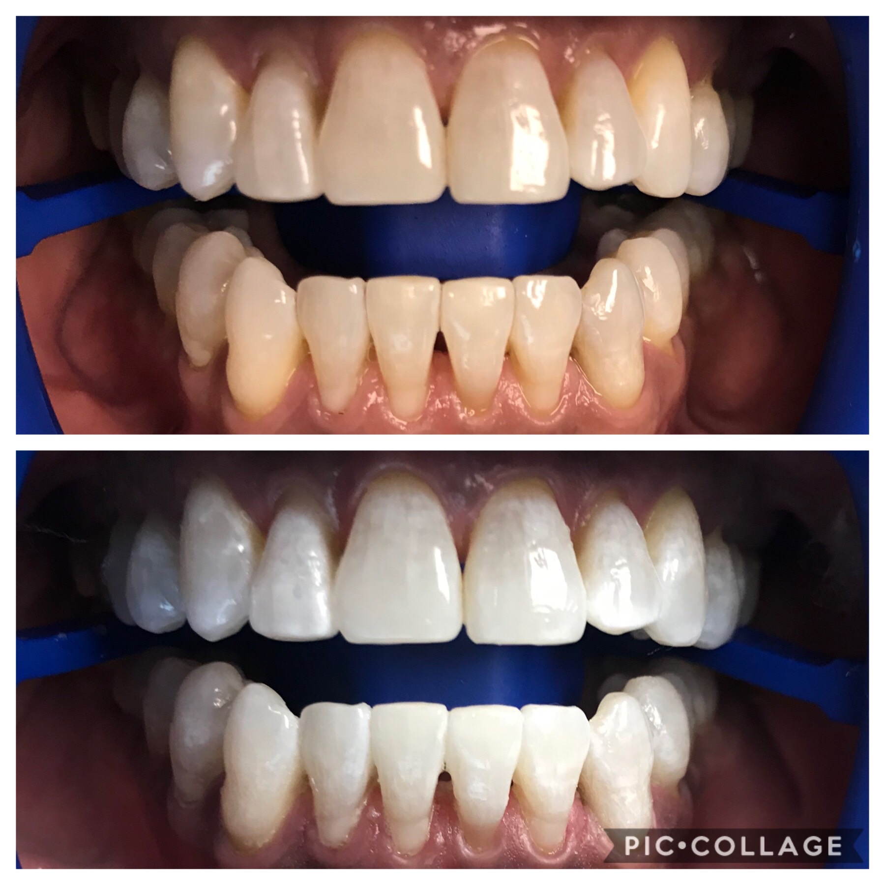 Teeth Whitening Tysons Corner Va Teeth Whitening in Tysons Corner