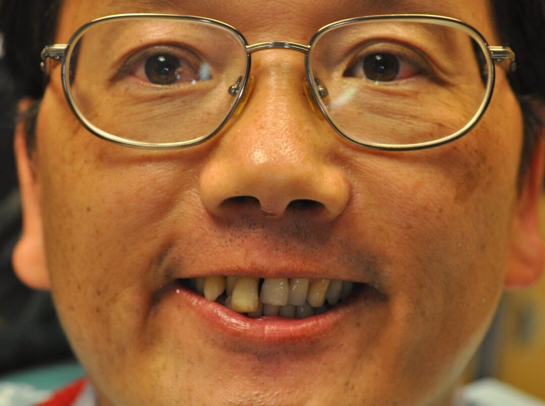 Dental Implants Tysons Corner Va Dental Implant in Tysons Corner