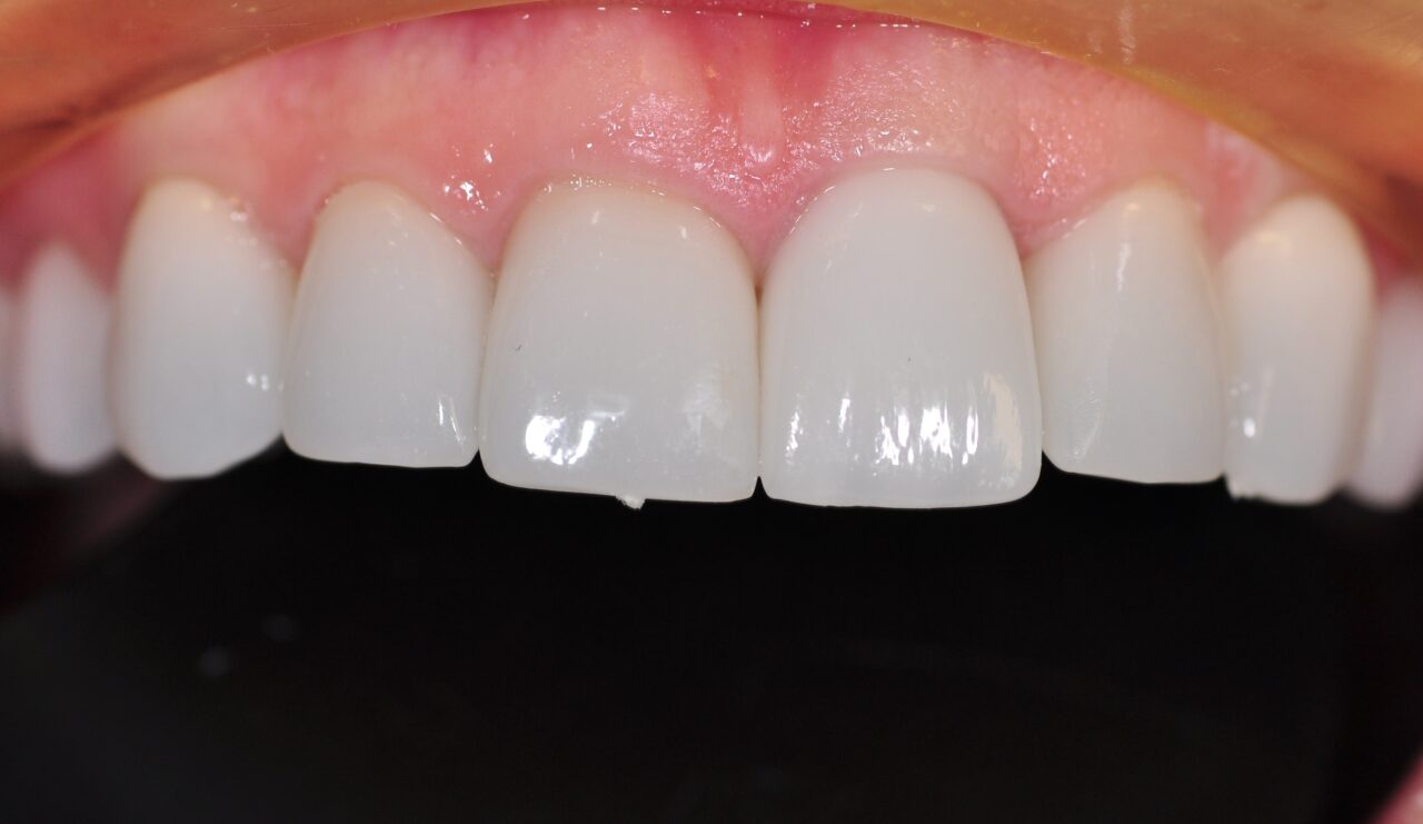 Dental Implants Tysons Corner Va Dental Implant in Tysons Corner