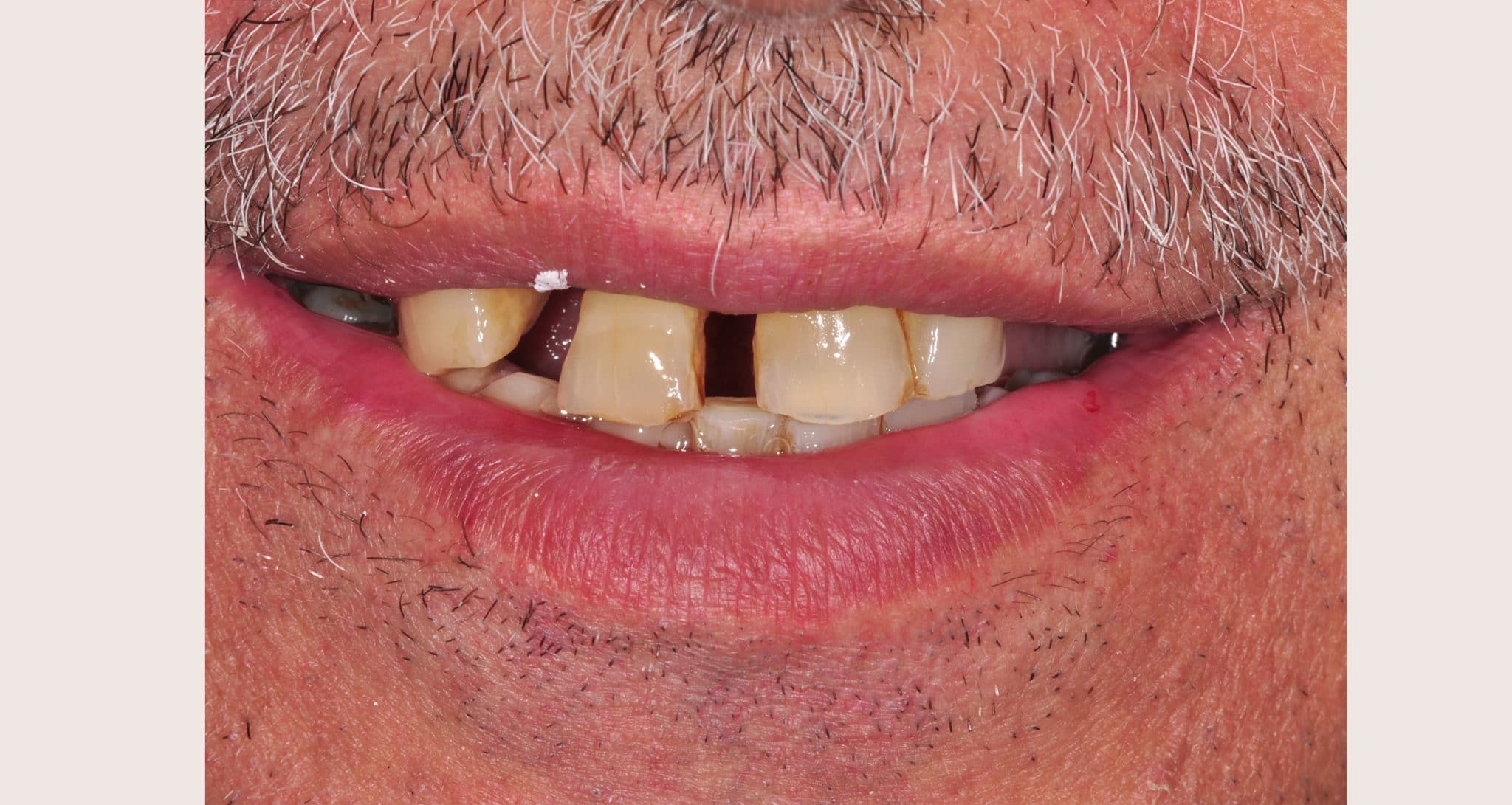 Dental Implants Tysons Corner Va Dental Implant in Tysons Corner