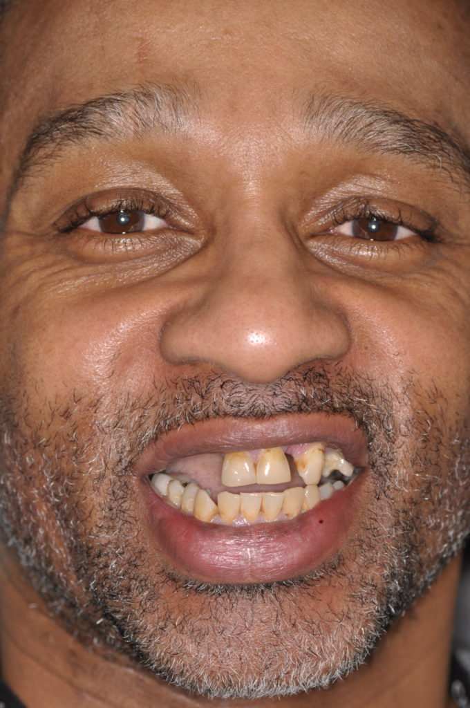 Dental Implants Tysons Corner Va Dental Implant in Tysons Corner