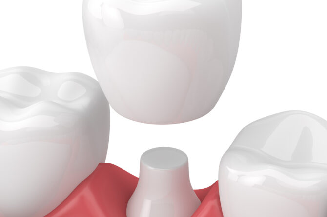 What You Need to Know About a Dental Crown