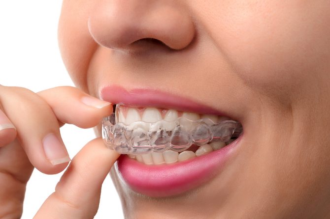 Reasons to Get Invisalign (Besides Straighter Teeth)