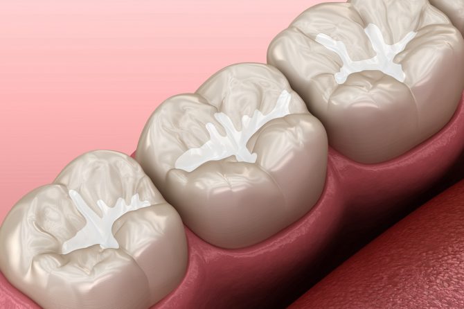 What are Dental Sealants?