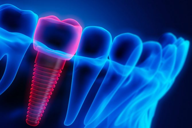 How Can Dental Implants Restore Your Natural Smile