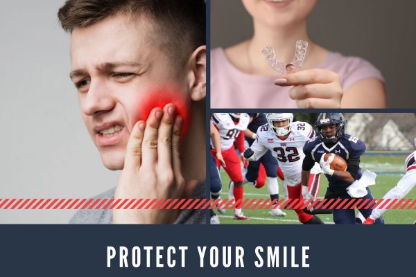 The Importance of Using Mouthguards: Guarding Your Best Smile