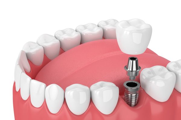 The Silent Threat: Why Gum Disease Should Never Be Ignored